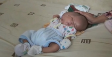 В Индонезии родился ребёнок с двумя лицами