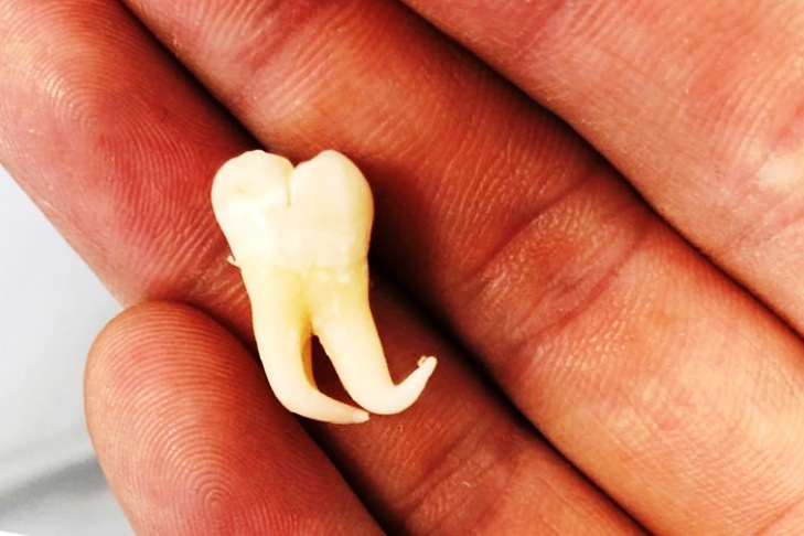 Удаление проблемного зуба мудрости или невыдуманная история о походе к стоматологу